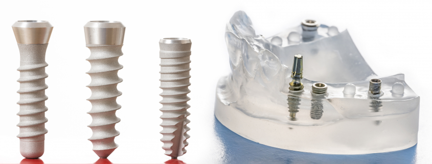 mitos y realidades sobre los implantes dentales