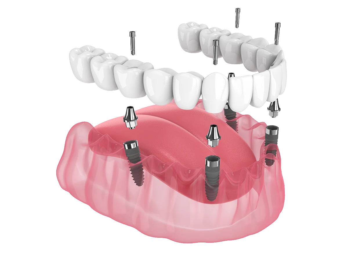 Implantes All on Four