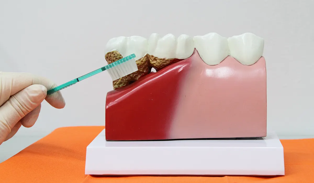 Síntomas de enfermedad periodontal