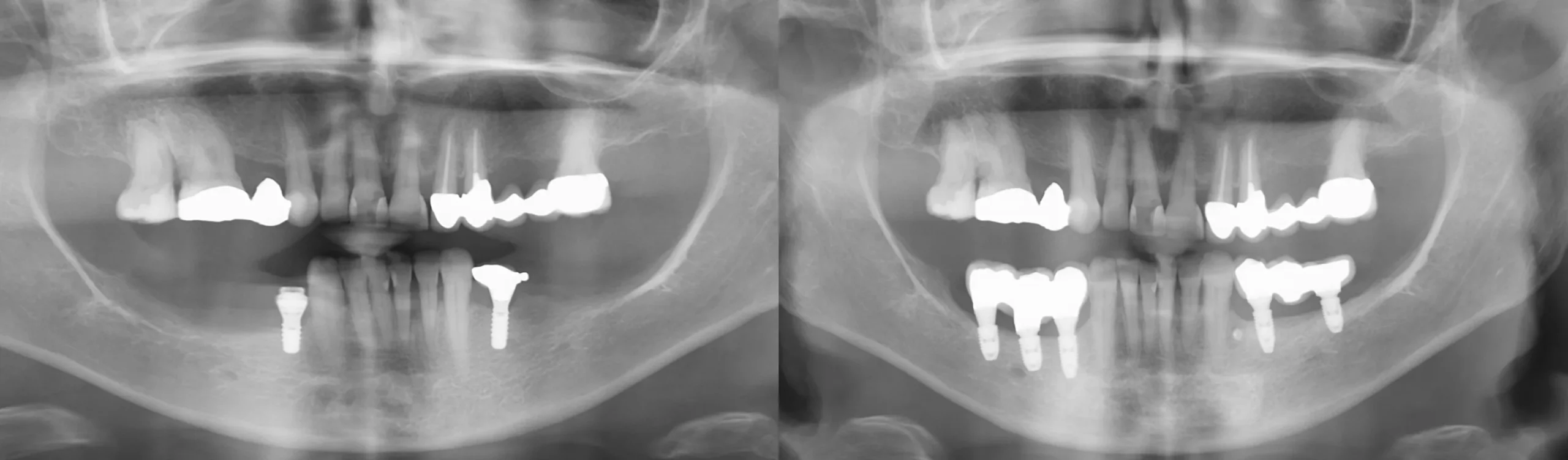 Antes y después caso RX