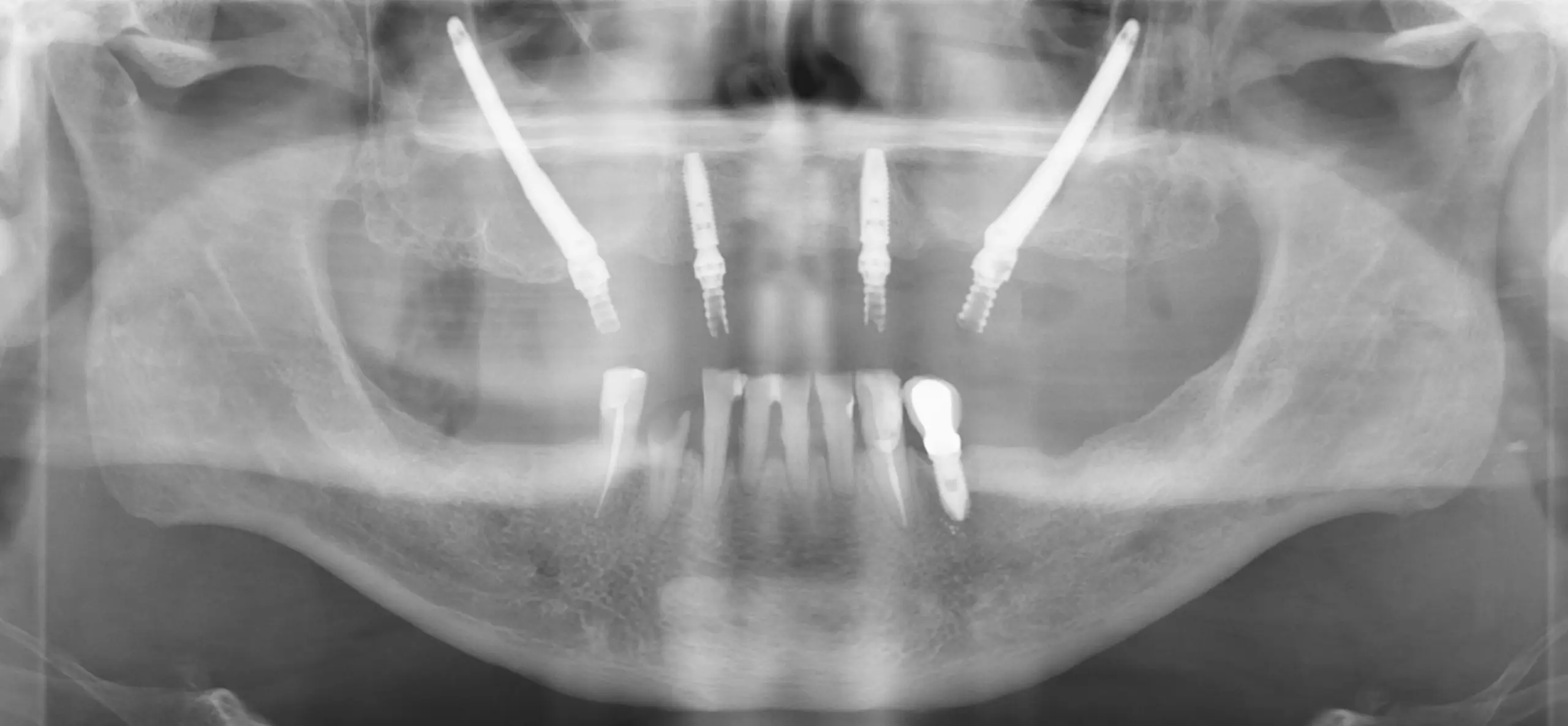 Implantes cigomáticos