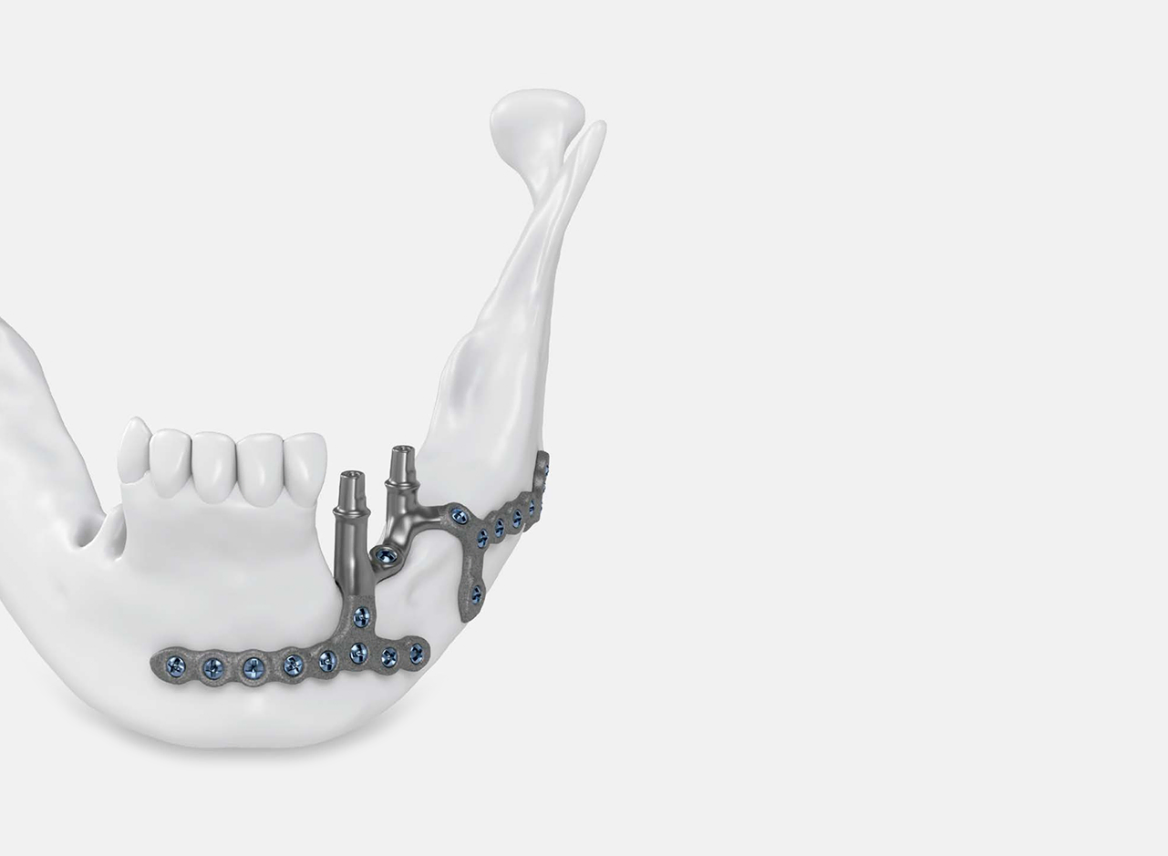 Implantes subperiósticos