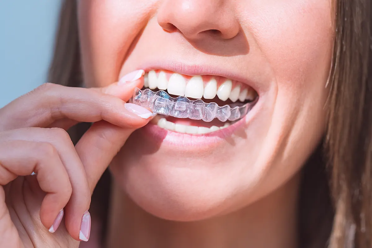 Beneficios de la ortodoncia invisible