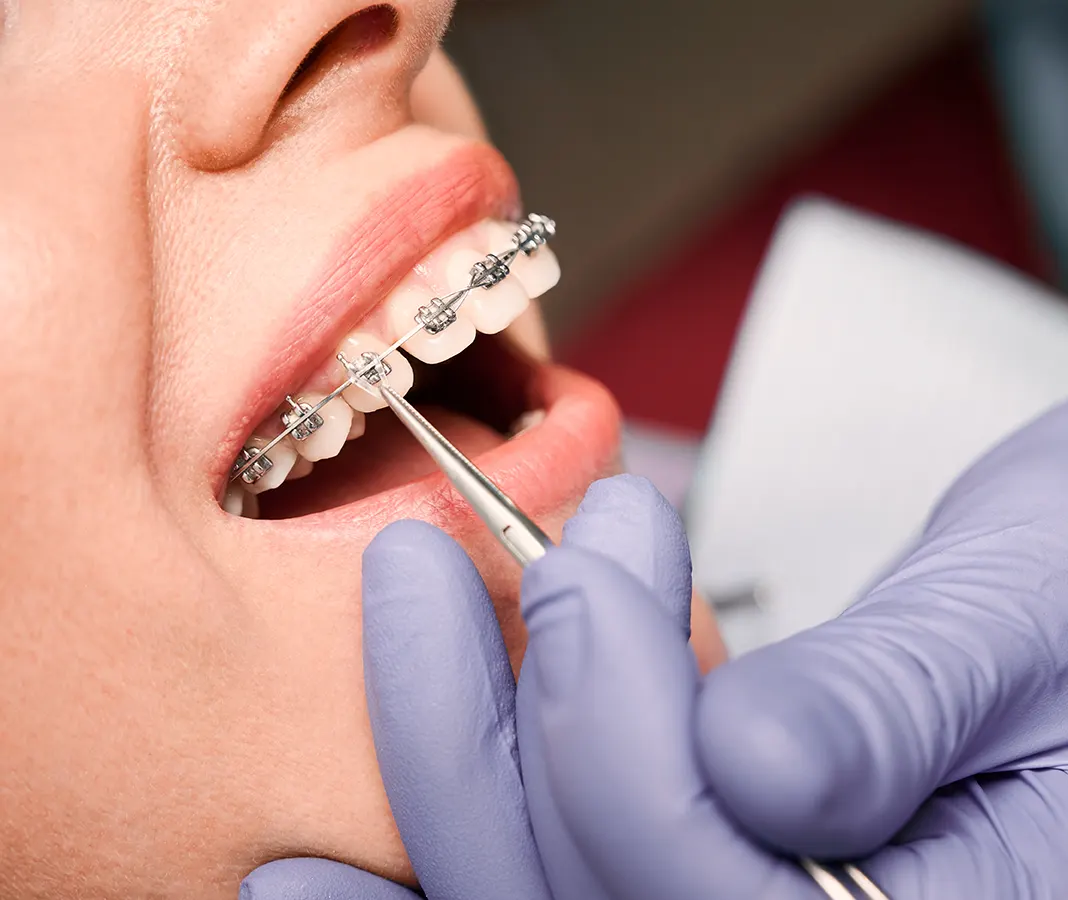 Brackets metálicos