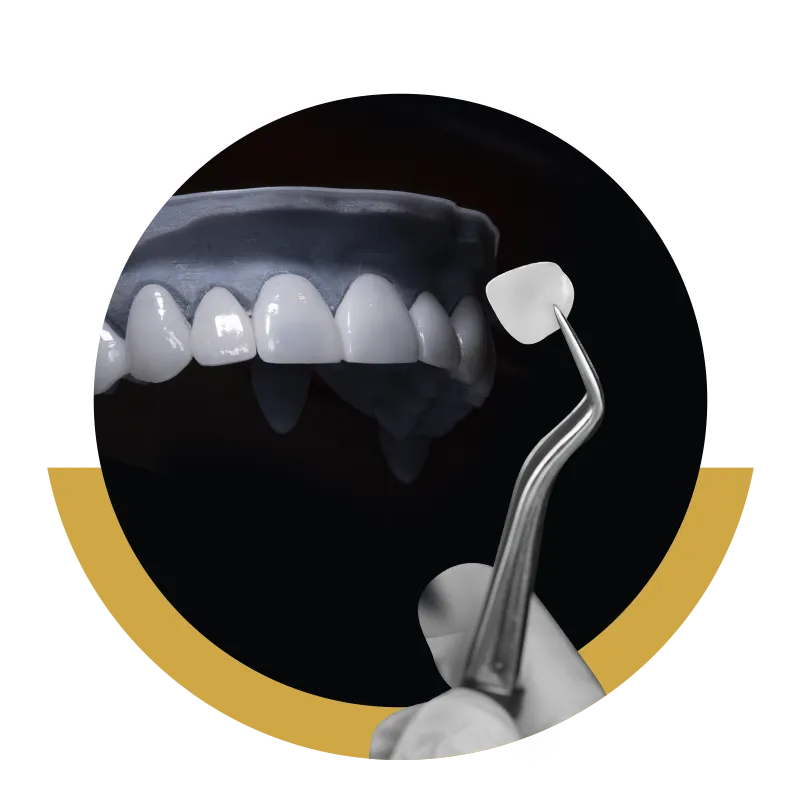 Carillas dentales Pamplona