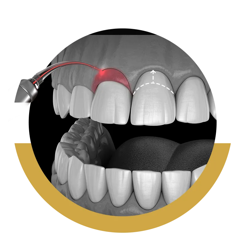 Gingivectomía Pamplona