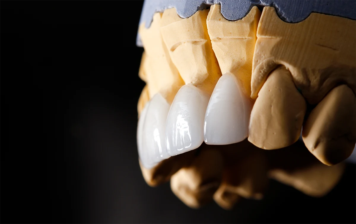 Carillas dentales
