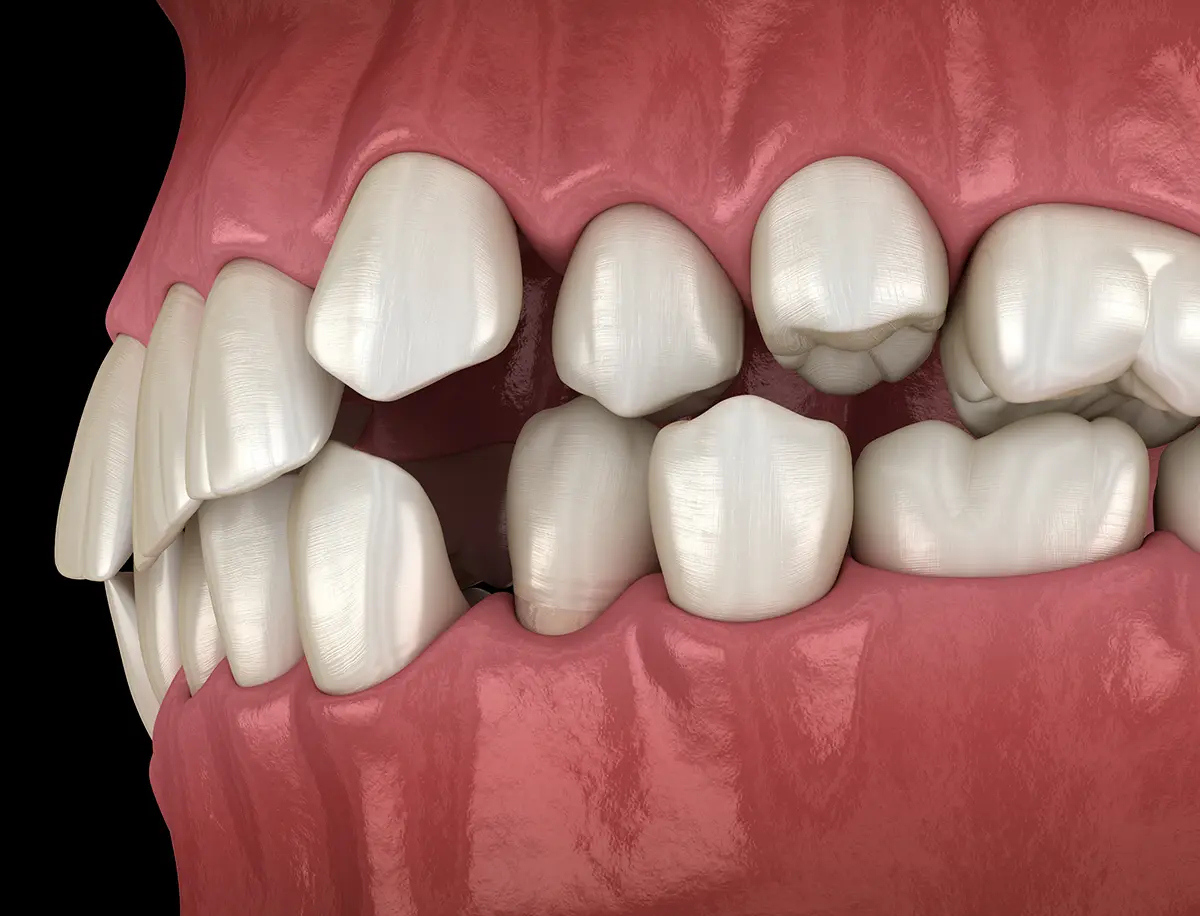 Diastemas y dientes apiñados
