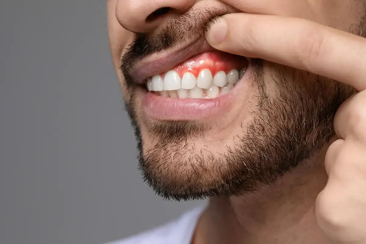 Enfermedad periodontal