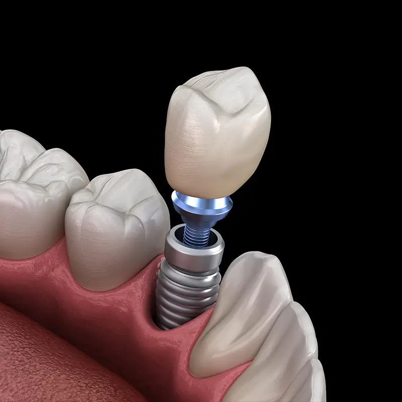 Implantes dentales