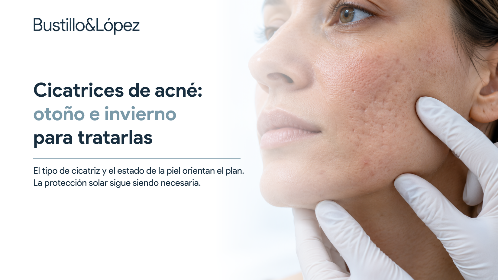 Cicatrices de acné: por qué otoño e invierno son buenos momentos para tratarlas