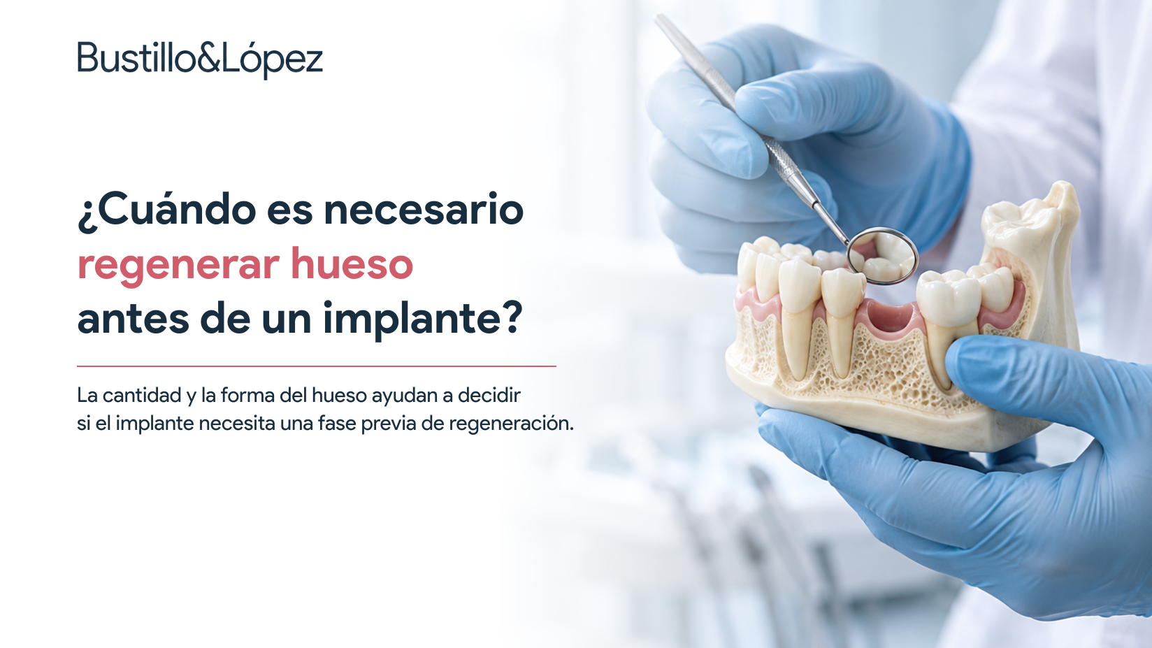 ¿Cuándo es necesario regenerar hueso antes de colocar un implante?